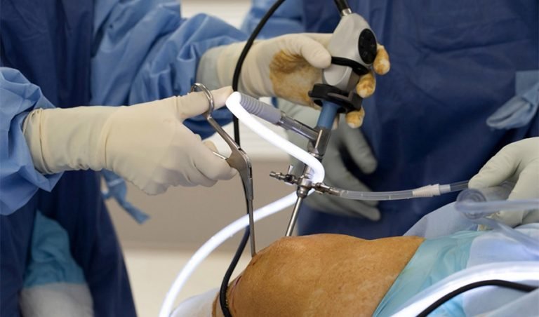 Arthroscopic Knee Surgery - Knee Sports Injury - Key Hole Surgery Knee