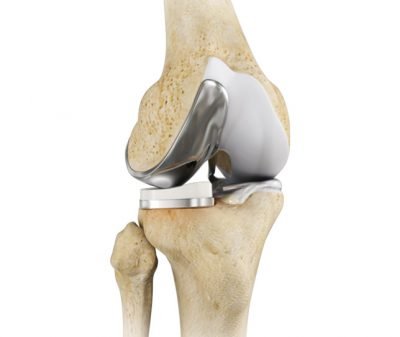 Inner (Medial) Partial Knee Replacement - Half Knee Replacement - Uni